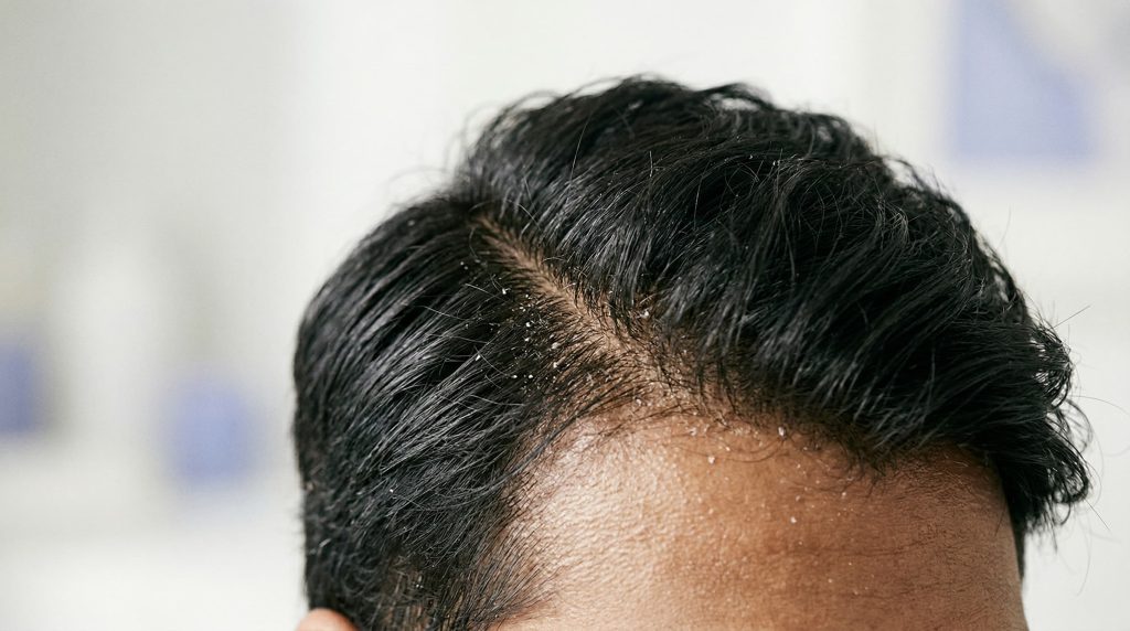 Man's scalp with dandruff flakes caused by hair product buildup