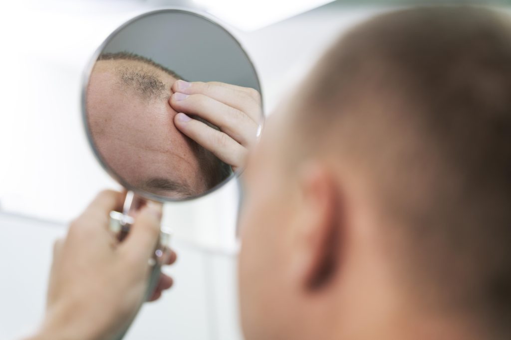 Man observing his balding head with a mirror