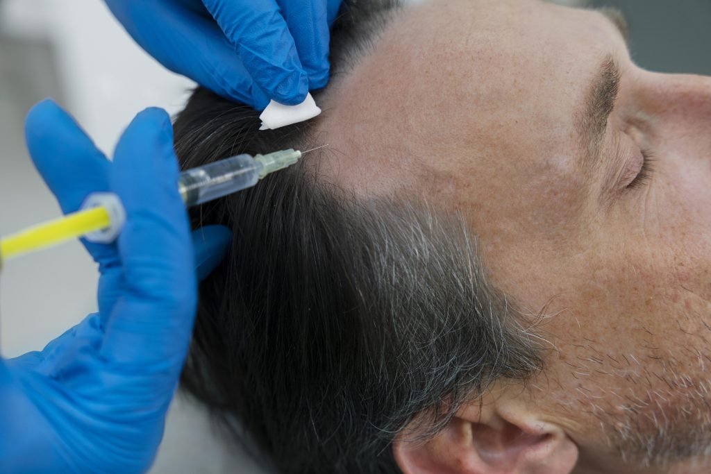 Man getting a hair transplant procedure