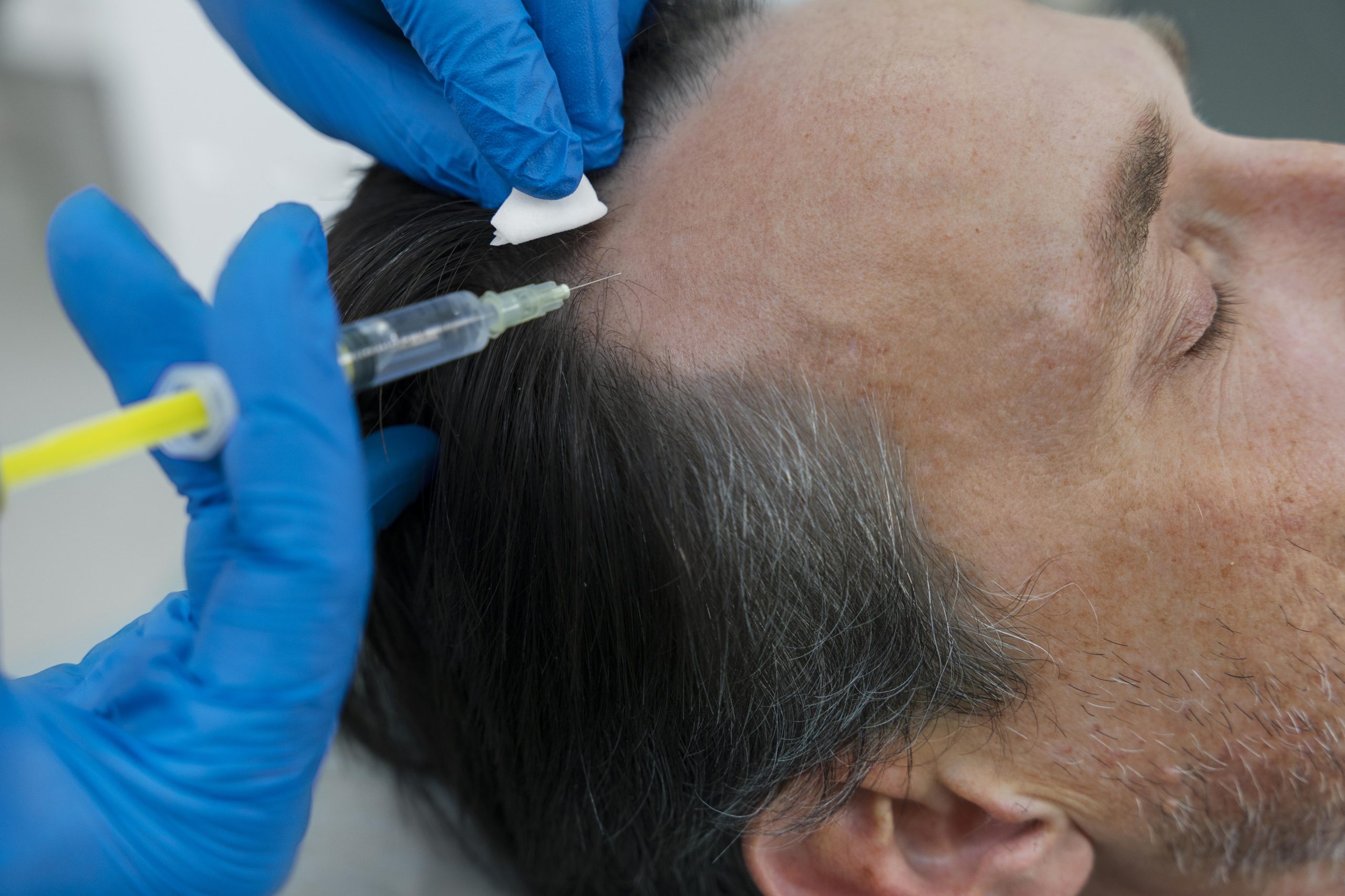Man getting a hair transplant procedure