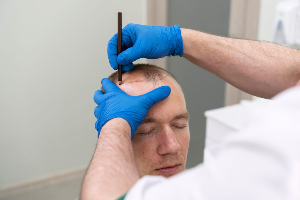Balding man getting hair transplant procedure to treat hair loss