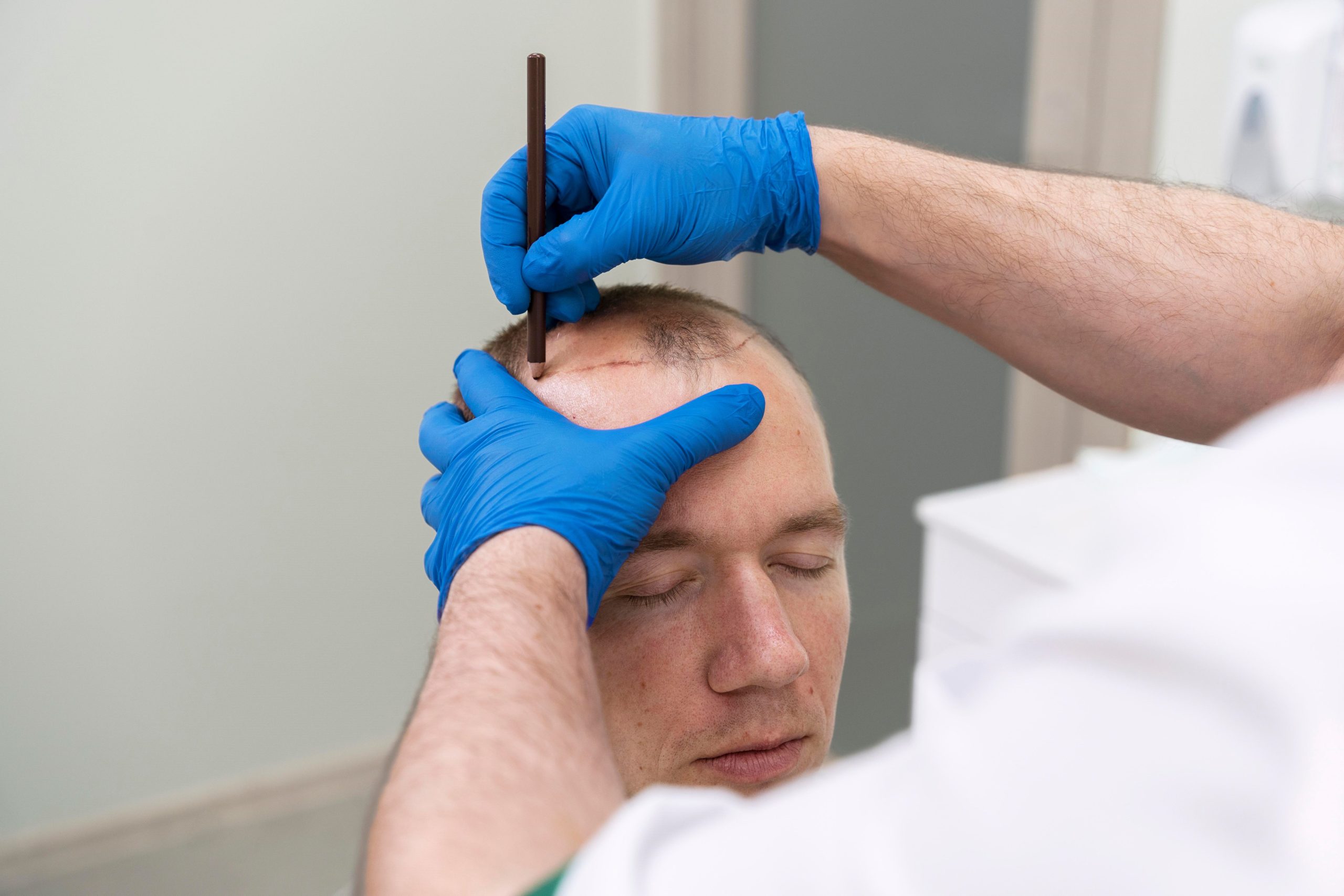Man undergoing hair transplant procedure